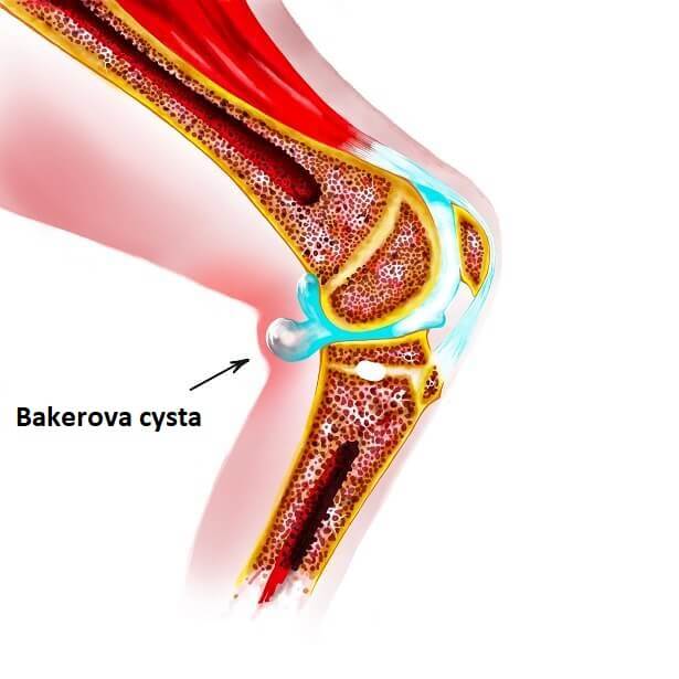 bakerova cysta